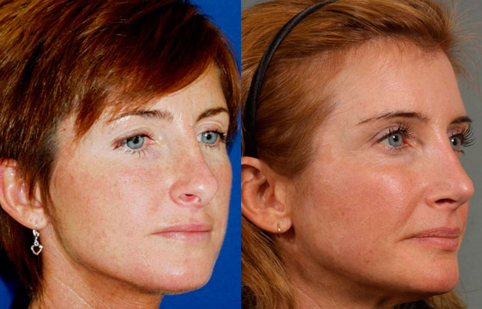 vicki-before-after-02