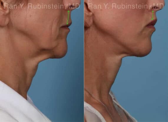 Lip Lift Before & After Photos