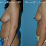 Abdominoplasty Before and After Photos in Montvale, NJ, Patient 12231
