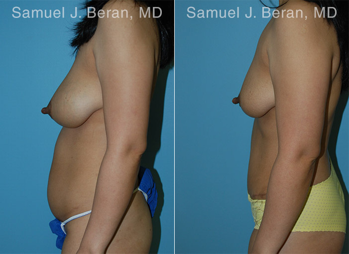 Abdominoplasty Before and After Photos in Montvale, NJ, Patient 12231