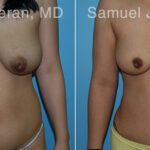 Abdominoplasty Before and After Photos in Montvale, NJ, Patient 12231