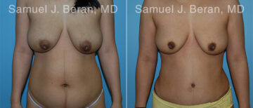 Abdominoplasty Before and After Photos in Montvale, NJ, Patient 12231