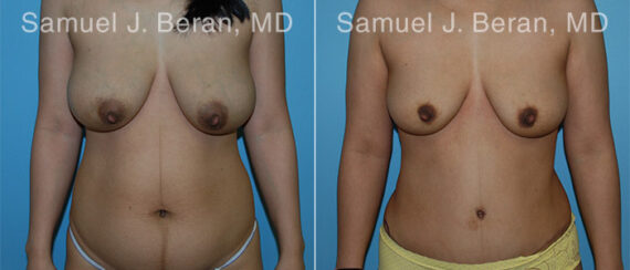 Abdominoplasty Before and After Photos in Montvale, NJ, Patient 12231