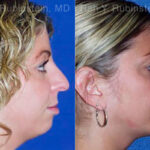 Chin Augmentation Before and After Photos in Montvale, NJ, Patient 12399