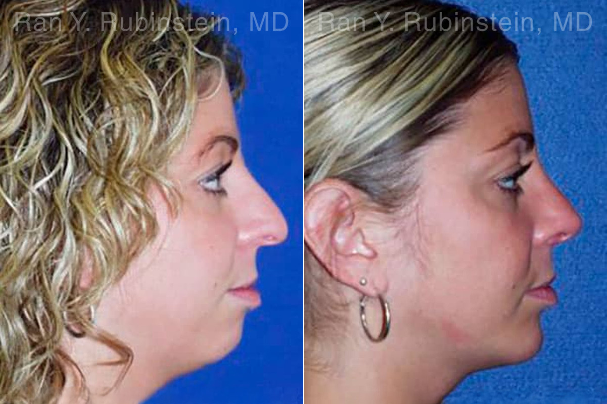 Chin Augmentation Before and After Photos in Montvale, NJ, Patient 12399