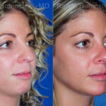Chin Augmentation Before and After Photos in Montvale, NJ, Patient 12399