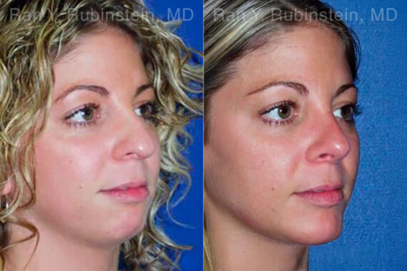 Chin Augmentation Before and After Photos in Montvale, NJ, Patient 12399