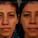 Ethnic Rhinoplasty Before and After Photos in Montvale, NJ, Patient 12573
