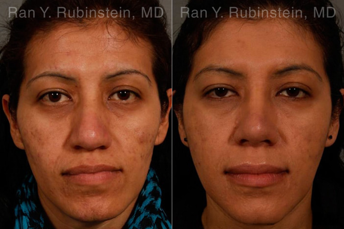 Ethnic Rhinoplasty Before and After Photos in Montvale, NJ, Patient 12573