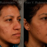 Ethnic Rhinoplasty Before and After Photos in Montvale, NJ, Patient 12573