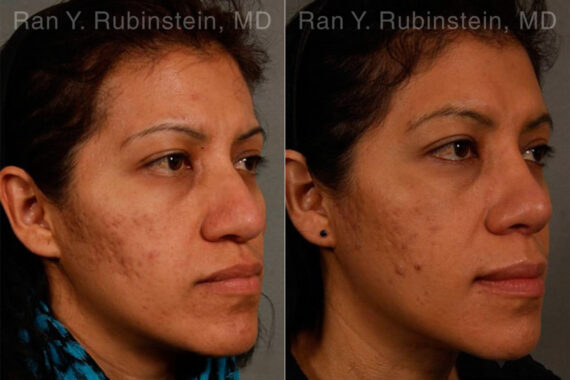 Ethnic Rhinoplasty Before and After Photos in Montvale, NJ, Patient 12573
