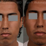 Ethnic Rhinoplasty Before and After Photos in Montvale, NJ, Patient 12578
