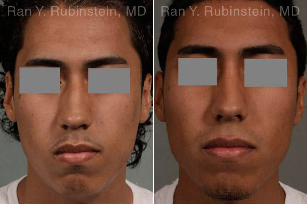 Ethnic Rhinoplasty Before and After Photos in Montvale, NJ, Patient 12578