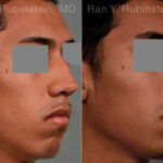 Ethnic Rhinoplasty Before and After Photos in Montvale, NJ, Patient 12578