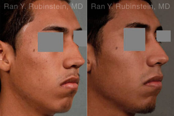 Ethnic Rhinoplasty Before and After Photos in Montvale, NJ, Patient 12578