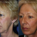 Face lift & Neck lift Before and After Photos in Montvale, NJ, Patient 12658