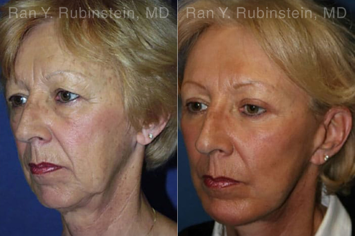 Face lift & Neck lift Before and After Photos in Montvale, NJ, Patient 12658