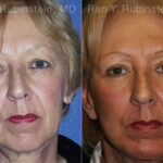 Face lift & Neck lift Before and After Photos in Montvale, NJ, Patient 12658