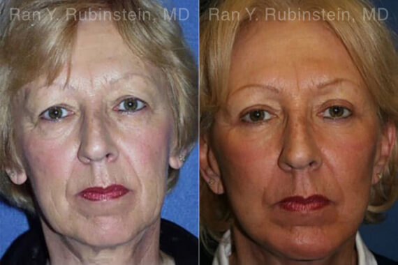 Face lift & Neck lift Before and After Photos in Montvale, NJ, Patient 12658
