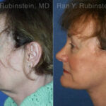 Face lift & Neck lift Before and After Photos in Montvale, NJ, Patient 12663