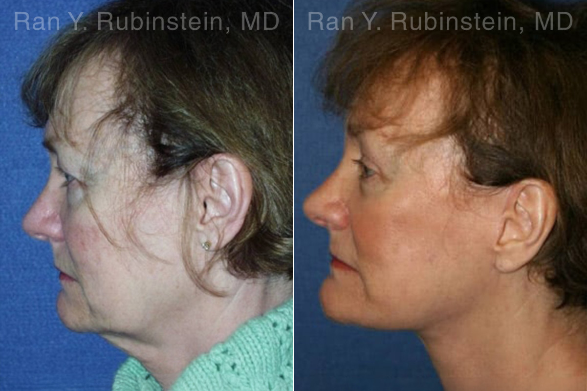 Face lift & Neck lift Before and After Photos in Montvale, NJ, Patient 12663