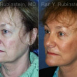 Face lift & Neck lift Before and After Photos in Montvale, NJ, Patient 12663