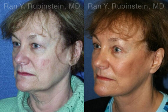 Face lift & Neck lift Before and After Photos in Montvale, NJ, Patient 12663