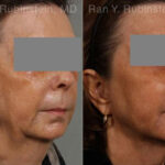 Dermal Fillers Before and After Photos in Montvale, NJ, Patient 12717