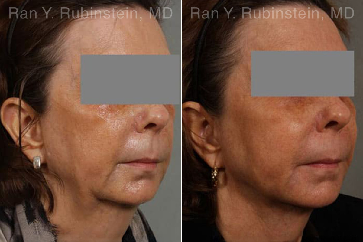 Dermal Fillers Before and After Photos in Montvale, NJ, Patient 12717