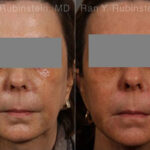 Dermal Fillers Before and After Photos in Montvale, NJ, Patient 12717