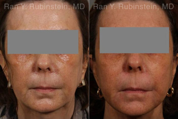 Dermal Fillers Before and After Photos in Montvale, NJ, Patient 12717