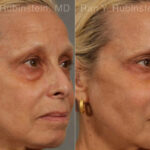 Dermal Fillers Before and After Photos in Montvale, NJ, Patient 12766