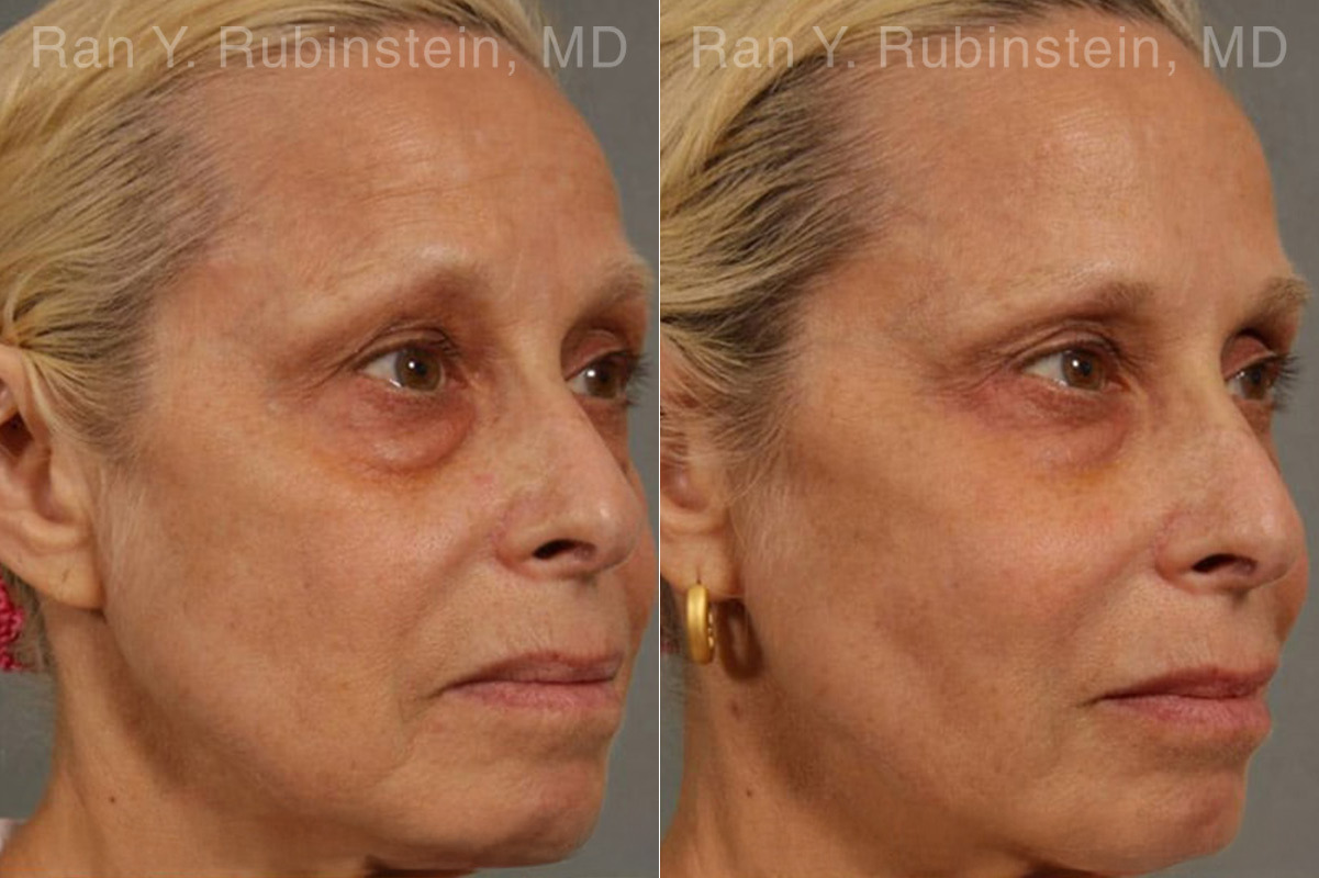 Dermal Fillers Before and After Photos in Montvale, NJ, Patient 12766