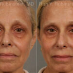 Dermal Fillers Before and After Photos in Montvale, NJ, Patient 12766