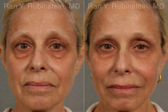 Dermal Fillers Before and After Photos in Montvale, NJ, Patient 12766