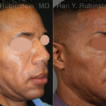 Sculptra Face Before and After Photos in Montvale, NJ, Patient 12771