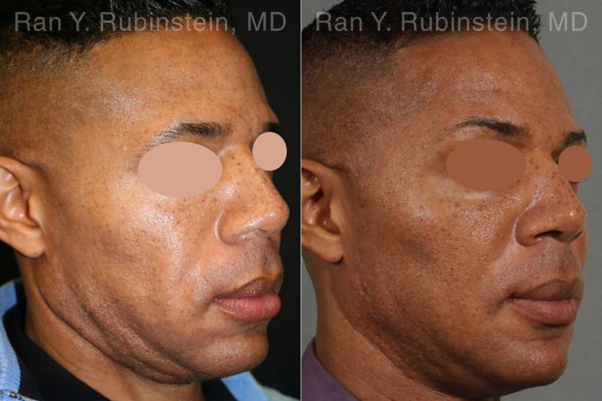 Sculptra Face Before and After Photos in Montvale, NJ, Patient 12771