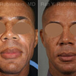 Sculptra Face Before and After Photos in Montvale, NJ, Patient 12771