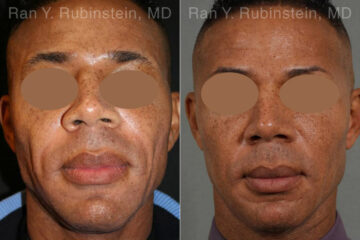 Sculptra Face Before and After Photos in Montvale, NJ, Patient 12771