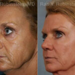 Laser Treatments Before and After Photos in Montvale, NJ, Patient 12820