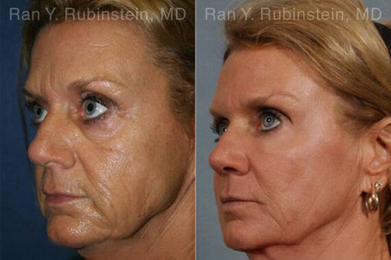 Laser Treatments Before and After Photos in Montvale, NJ, Patient 12820