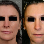 Laser Treatments Before and After Photos in Montvale, NJ, Patient 12839