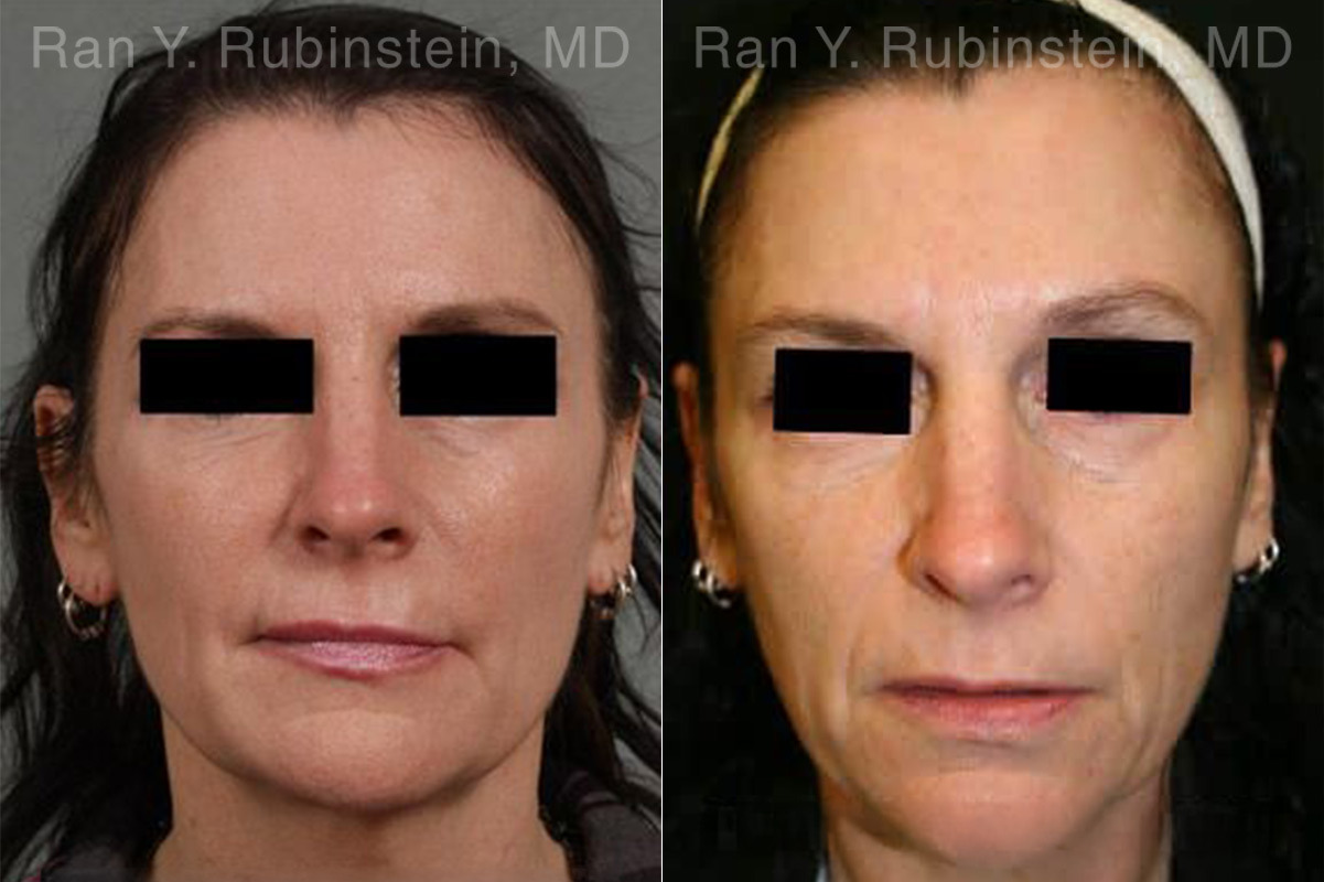 Laser Treatments Before and After Photos in Montvale, NJ, Patient 12839
