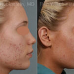 Laser Treatments Before and After Photos in Montvale, NJ, Patient 12842
