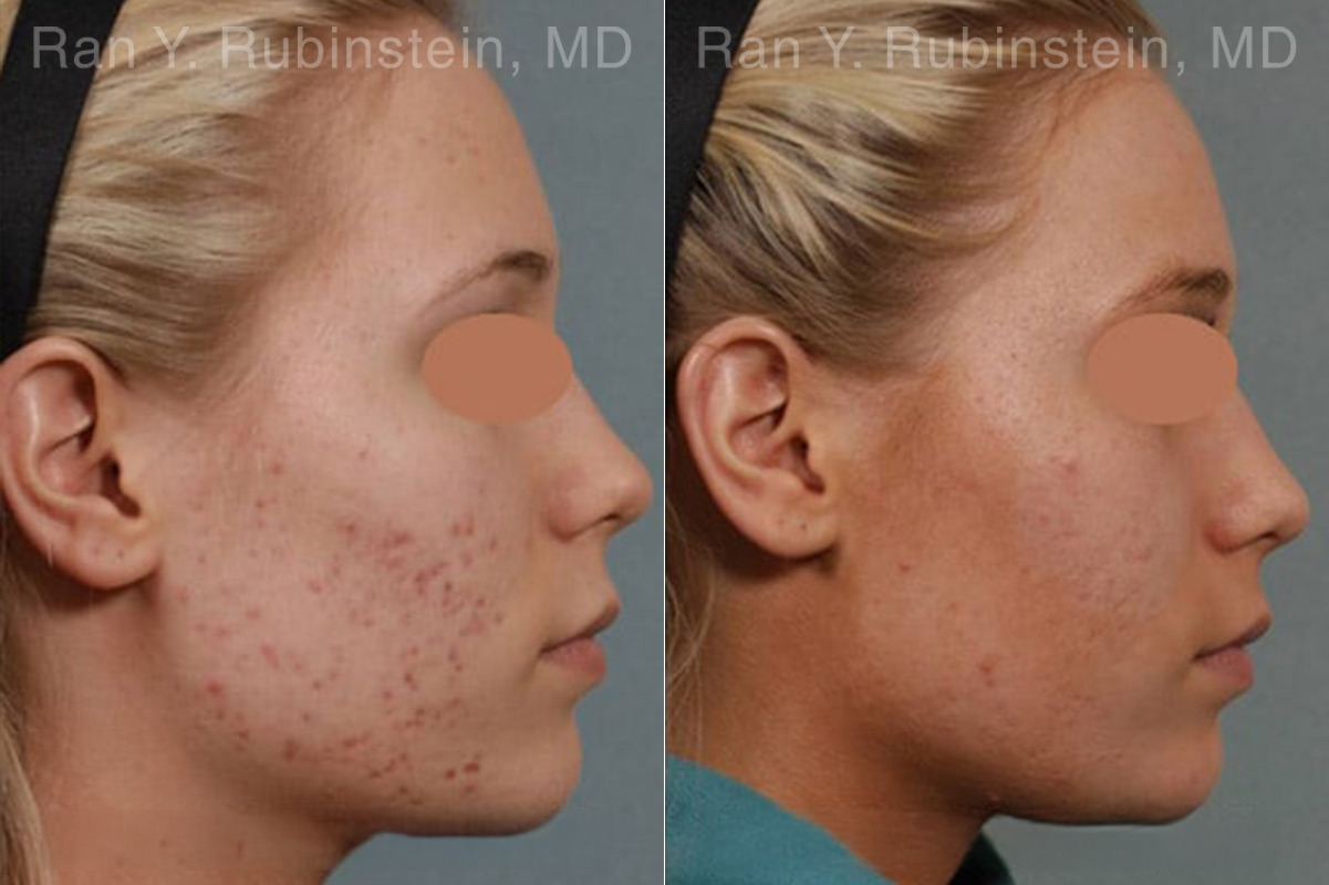 Laser Treatments Before and After Photos in Montvale, NJ, Patient 12842