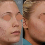 Laser Treatments Before and After Photos in Montvale, NJ, Patient 12842