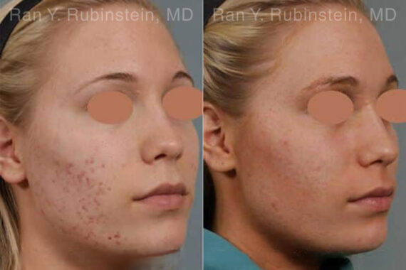 Laser Treatments Before and After Photos in Montvale, NJ, Patient 12842