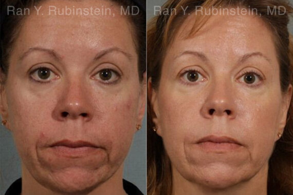 Laser Treatments Before and After Photos in Montvale, NJ, Patient 12847