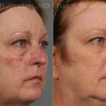 Laser Treatments Before and After Photos in Montvale, NJ, Patient 12850