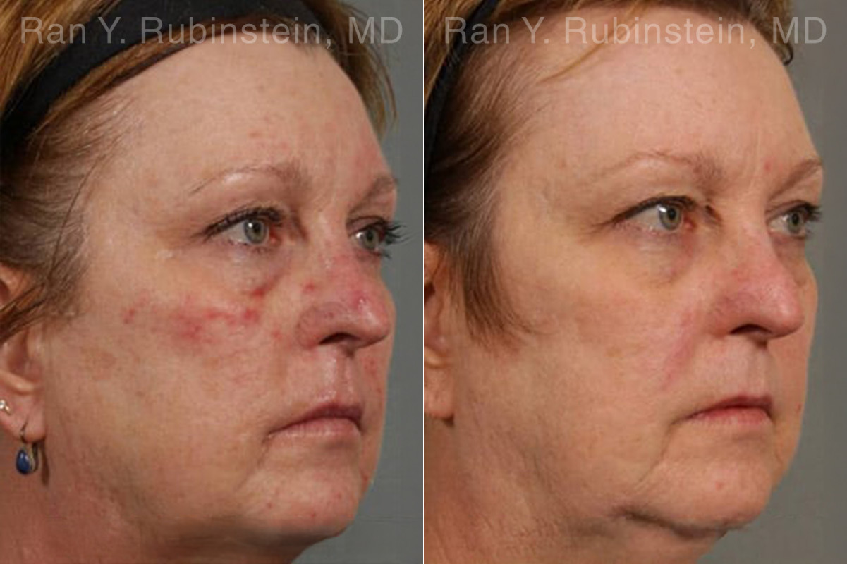 Laser Treatments Before and After Photos in Montvale, NJ, Patient 12850